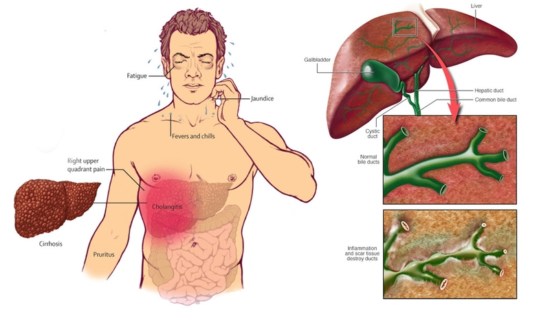 Các biện pháp điều trị xơ gan mà bạn nên biết 2