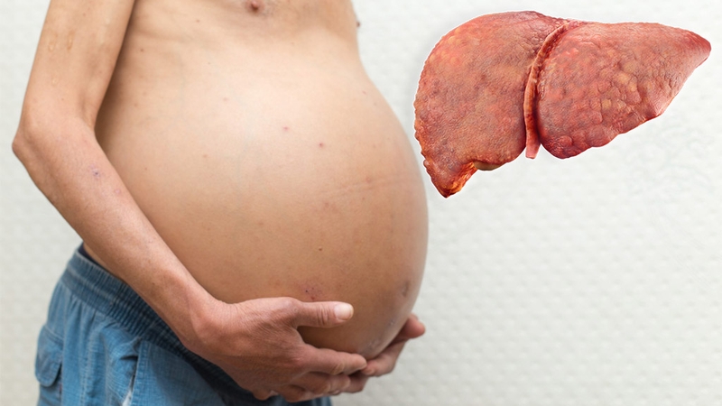 Các biện pháp điều trị xơ gan mà bạn nên biết 3