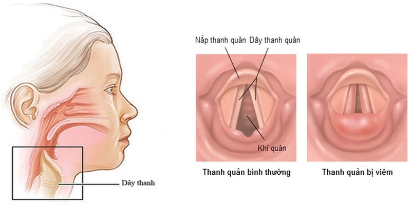 Các biện pháp giảm tình trạng khàn tiếng 2