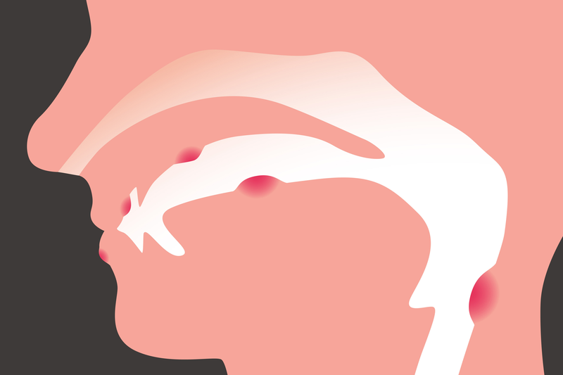 Các biện pháp phòng ngừa ung thư khoang miệng cần biết 1