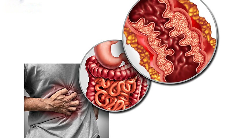 Các biểu hiện của đau ruột thừa bạn cần biết 2