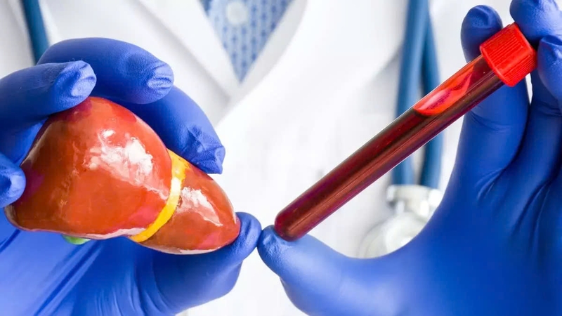 Các biểu hiện ngoài da của bệnh gan: Dấu hiệu không nên bỏ qua 3