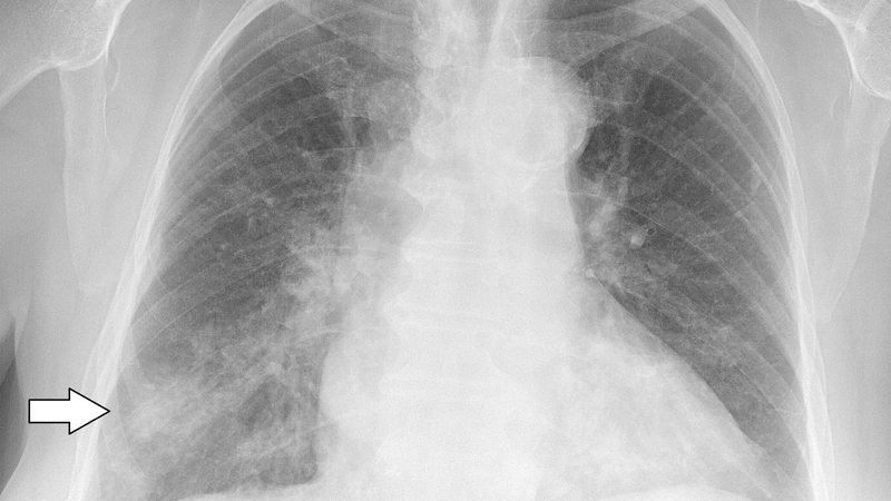 Các bước đọc X quang ngực cơ bản: Hướng dẫn và phân tích kết quả 3