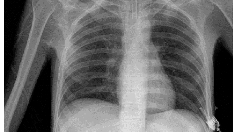 Các bước đọc X quang ngực cơ bản: Hướng dẫn và phân tích kết quả 4