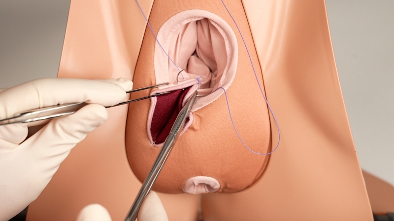 Các bước rạch tầng sinh môn trong quá trình sinh nở 1