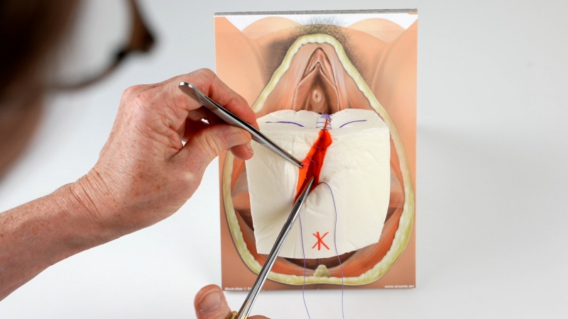 Các bước rạch tầng sinh môn trong quá trình sinh nở 2