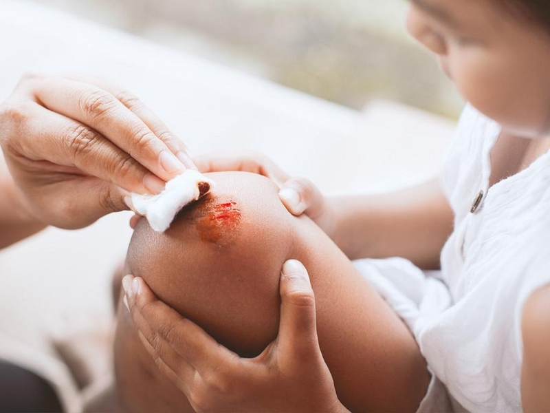 Các bước sơ cứu cầm máu vết thương ở tĩnh mạch và mao mạch 2