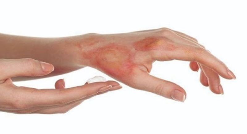 Hướng dẫn chi tiết các bước sơ cứu khi bị bỏng hiệu quả nhất 3