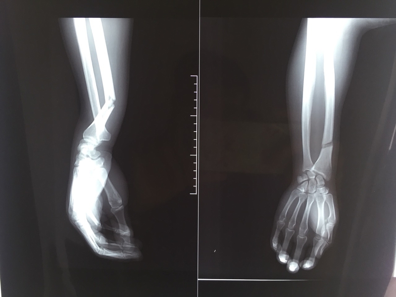 Các bước sơ cứu và băng bó cho người gãy xương cẳng tay 1