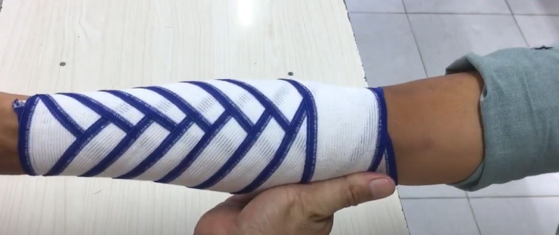 Các bước sơ cứu và băng bó cho người gãy xương cẳng tay 5