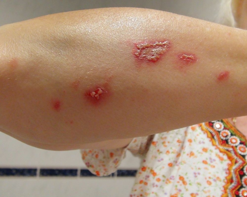 Các bước xử lý và cách trị kiến ba khoang cắn 2