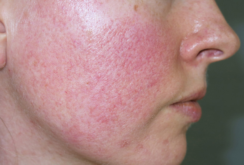 Các cách thải độc da nhiễm corticoid tại nhà hiệu quả 1