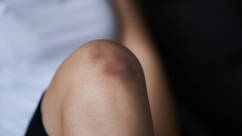 Các cách trị thâm đầu gối hiệu quả tại nhà 1