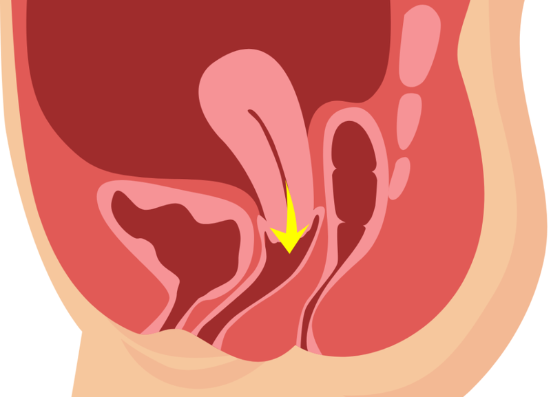 Các cấp độ của sa sinh dục: Triệu chứng, nguyên nhân và cách điều trị 1
