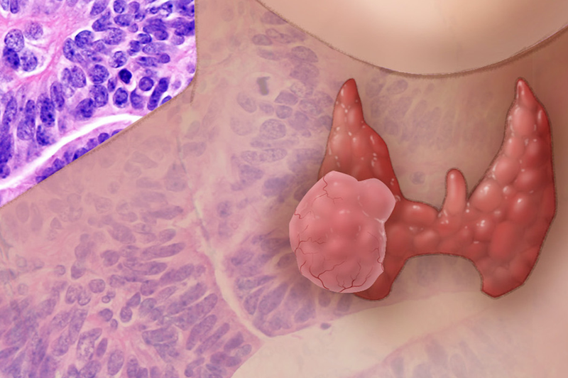 Các chỉ số xét nghiệm máu ung thư tuyến giáp 1