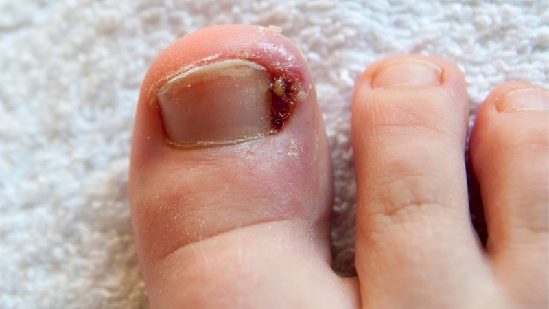 Các chín mé thường gặp là gì? Cách chữa trị và phòng bệnh chín mé 1