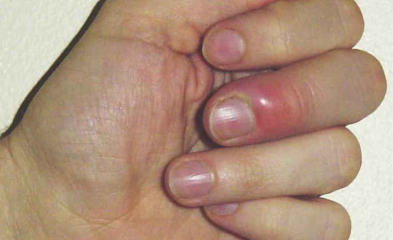 Các chín mé thường gặp là gì? Cách chữa trị và phòng bệnh chín mé 3