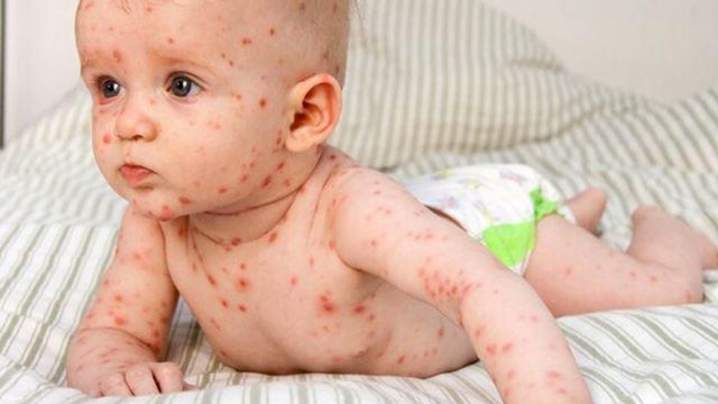 Các dấu hiệu bị sởi ở trẻ cha mẹ không nên bỏ qua 3