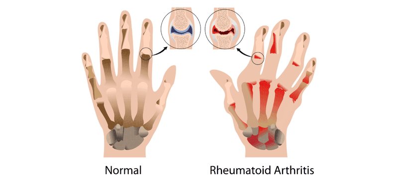 Các dấu hiệu cảnh báo viêm khớp dạng thấp 2
