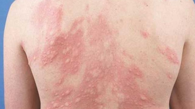 Trong tất cả các trường hợp nổi mề đay do HIV, nổi bật nhất là da có biểu hiện nổi mẩn đỏ từng mảng hoặc loang lổ