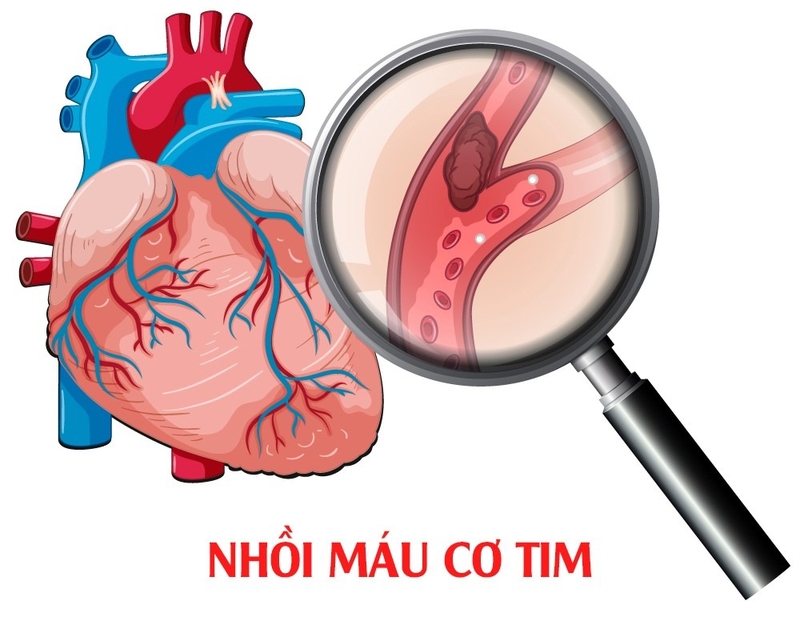 Các dấu hiệu nhồi máu cơ tim ở phụ nữ không thể bỏ qua