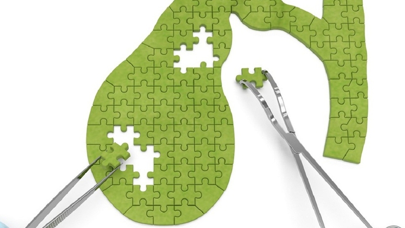 Các dấu hiệu sỏi mật dễ nhận biết và phương pháp điều trị phổ biến mà bạn nên biết 4