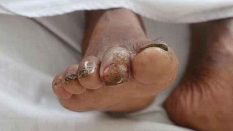 Các dấu hiệu, triệu chứng bệnh Whitmore bạn nên biết