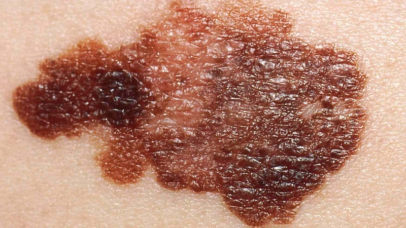 Các dấu hiệu ung thư da là gì? Biện pháp phòng tránh bệnh ung thư da 2