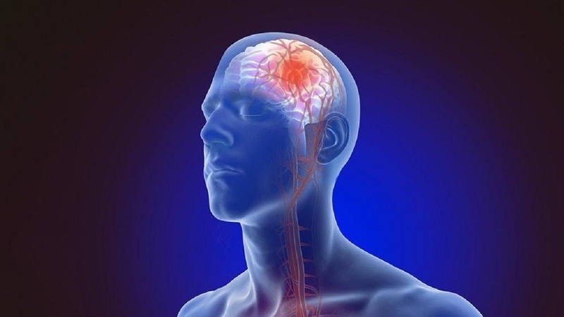 Các di chứng nhồi máu não nếu không được điều trị kịp thời 1