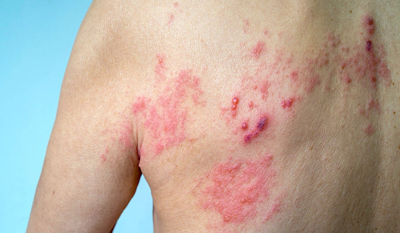 Các điểm tiêm phòng zona ở Đà Nẵng thuộc Hệ thống Tiêm chủng Long Châu 1