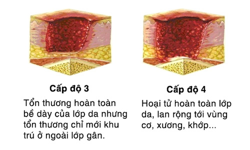 Các giai đoạn loét tì đè và cách điều trị hiệu quả 1