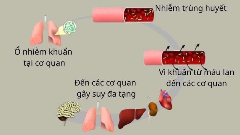 Các giai đoạn của nhiễm khuẩn huyết: Nguy cơ, dấu hiệu và phương pháp điều trị 3