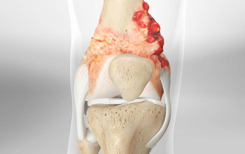 Các giai đoạn của Sarcoma xương (U xương ác tính) ở trẻ em và thanh thiếu niên 1