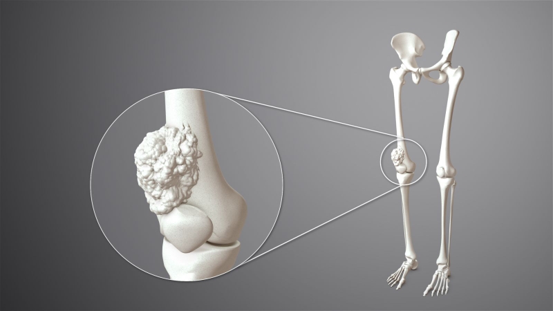 Các giai đoạn của Sarcoma xương (U xương ác tính) ở trẻ em và thanh thiếu niên 2