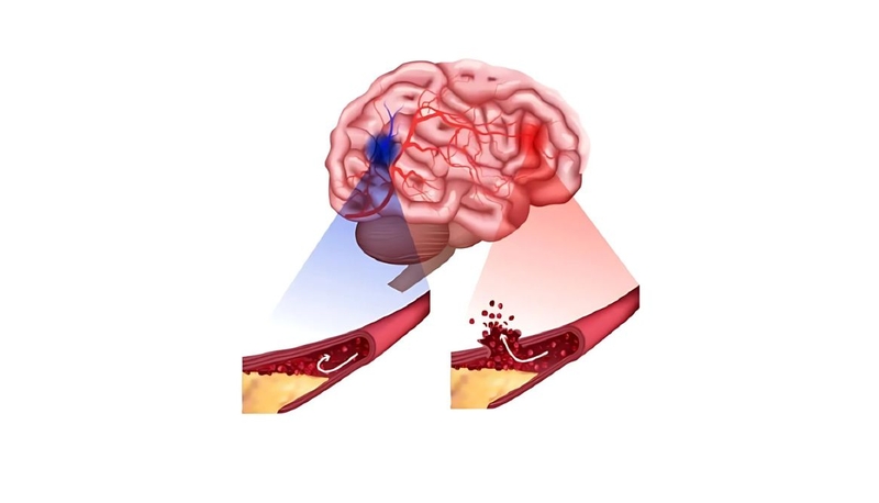 Các giai đoạn của tai biến mạch máu não​: Hiểu rõ để bảo vệ tính mạng 1