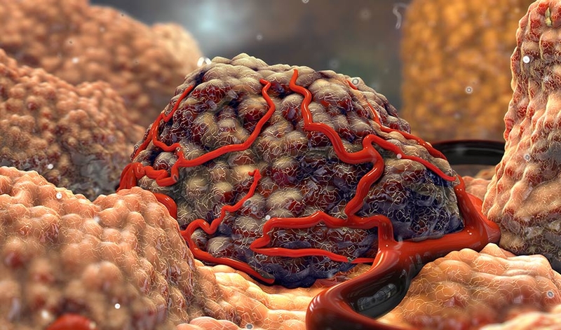 Các giai đoạn của u tế bào mầm ở trẻ em - Đọc ngay! 1