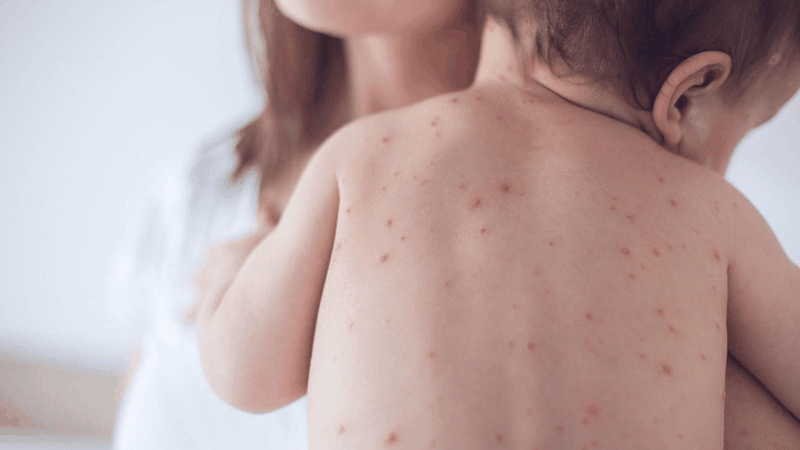 Các giai đoạn phát triển của bệnh Rubella 1
