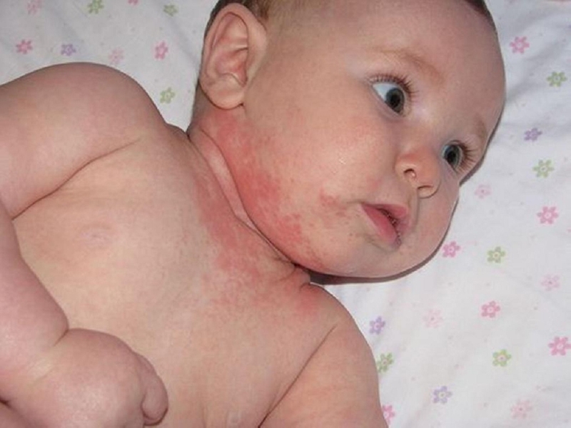 Các giai đoạn phát triển của bệnh Rubella 2