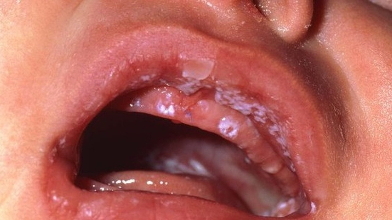 Các hình ảnh nấm lưỡi của bé để giúp phát hiện bệnh sớm -3