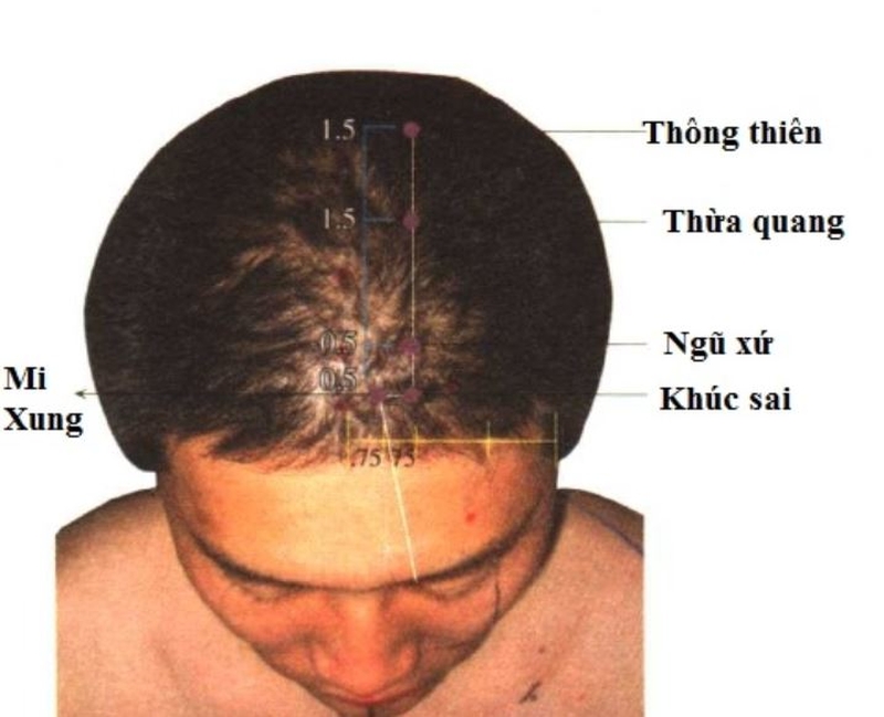 Các huyệt đạo trên đầu có tác dụng gì - Bạn đã biết chưa? 3