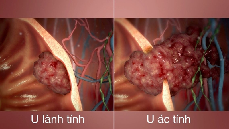 U lành tính và u ác tính có nhiều điểm khác biệt đáng kể