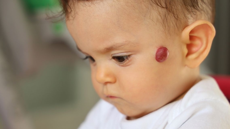 Một số u lành tính như u máu không gây triệu chứng và chỉ cần theo dõi
