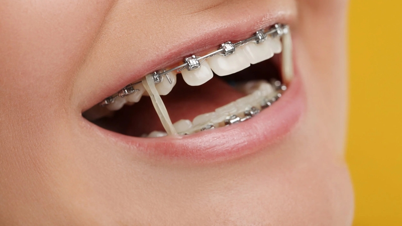 Chun cắn chéo giúp hỗ trợ đưa răng mọc lệch về đúng vị trí