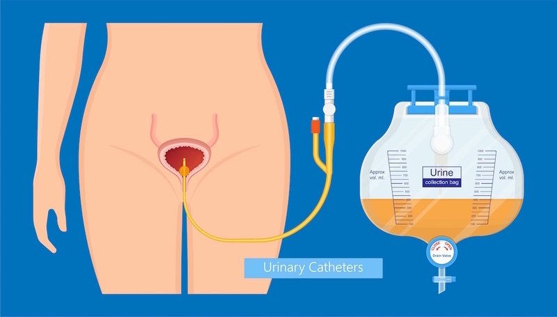 Các kỹ thuật bơm rửa bàng quang phổ biến hiện nay 1