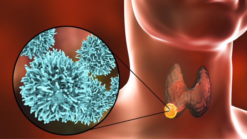 Các loại bệnh lý tuyến giáp thường gặp 3