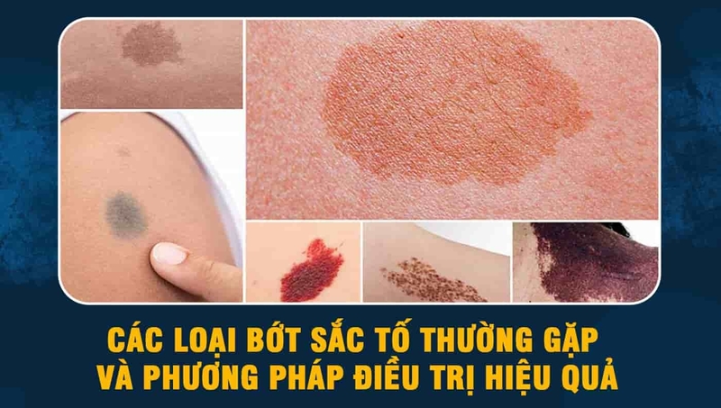 Vết bớt là gì? Chúng có gây hại không? 3