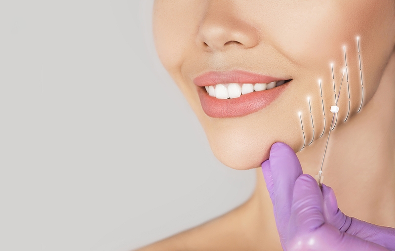 Có bao nhiêu loại chỉ căng da mặt? Các loại chỉ căng da mặt thông dụng nhất hiện nay?