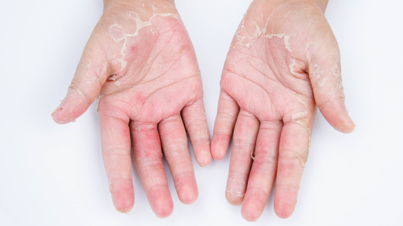 Các loại dị ứng da phổ biến hiện nay