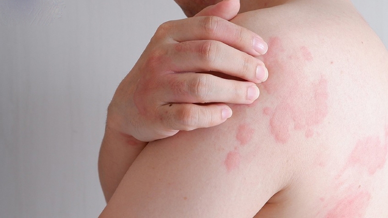 Các loại dị ứng​ thường gặp và cách phòng ngừa hiệu quả 2