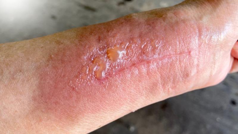 Các loại dị ứng​ thường gặp và cách phòng ngừa hiệu quả 5